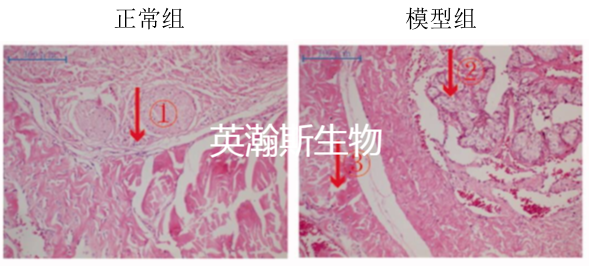 勃起功能障碍模型.png